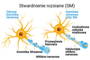 Leczenie Stwardnienia Rozsianego Polem Magnetycznym